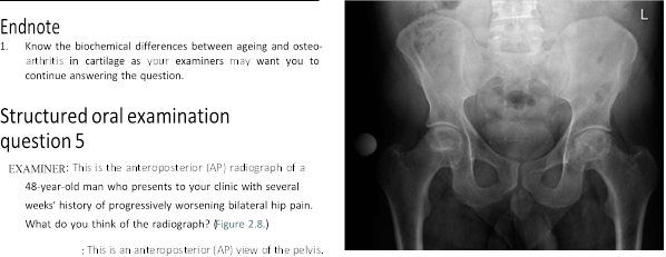 Illustration 2 for Is Your Femoral Head Affected? Understanding Hip Osteoarthritis