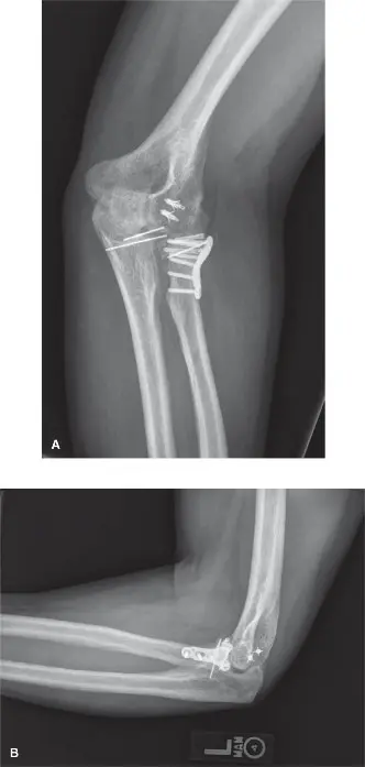 صورة توضيحية لـ إصابة ثلاثي الكوع الرهيب: دليلك الشامل للتشخيص والعلاج والتعافي مع الأستاذ الدكتور محمد هطيف في صنعاء