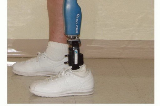 صورة توضيحية لـ بتر فوق الركبة: دليل شامل للمرضى وخيارات التعافي مع الأستاذ الدكتور محمد هطيف