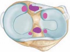 Knee Arthroscopy: The Basic Essentials Explained Simply