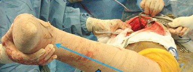 Illustration 16 for Mastering Soft Tissue Balancing for Optimal THR Outcomes