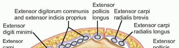 Intramedullary and Dorsal Plate Fixation of Distal Radius Fractures