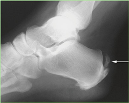 Illustration 37 for First Metatarsal Surgery: Expert Solutions for Foot & Ankle Pain