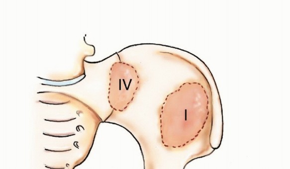 Pelvic Metastasis Surgery: A Component of the Utilitarian Approach