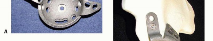 Illustration 8 for Pelvic Discontinuity: Understanding Superior and Inferior Separation