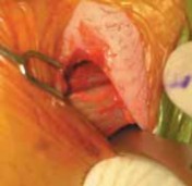 Adductor-Related Groin Pain: What Athletes Need to Know