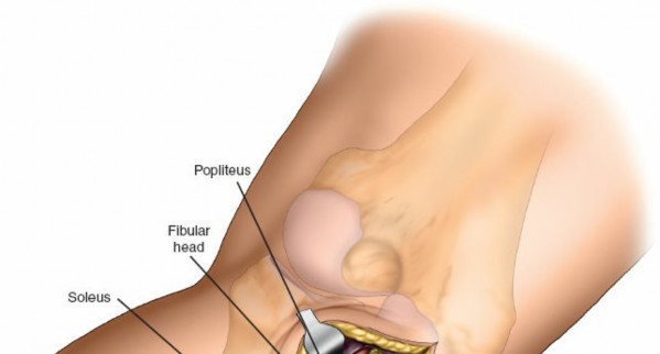 Figure 3: Biomechanical principle of buttress plating for posterolateral tibial plateau fractures.