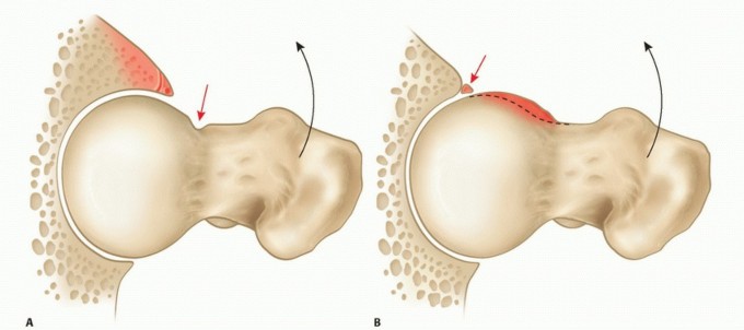 FAI & Hip Pain: The Crucial Center Edge Angle Explained