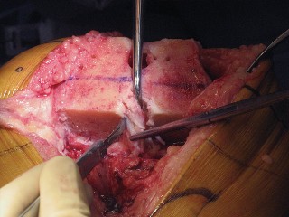 Illustration 33 for Posterior Stabilized Technique: Essential Insights for TKA Success