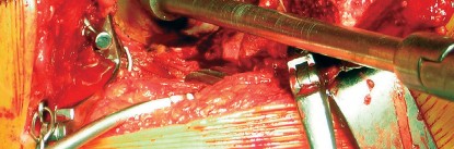 صورة طبية: طول عمر مكون الحُق الأسمنتي في مفصل الورك: مفتاح الاستقرار والديمومة مع الأستاذ الدكتور محمد هطيف في صنعاء