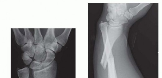 Reduction and Stabilization of the Distal Radioulnar Joint following Galeazzi Fractures