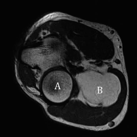 Conquer Your Lipoma Examination Question: Orthopaedic Oncology