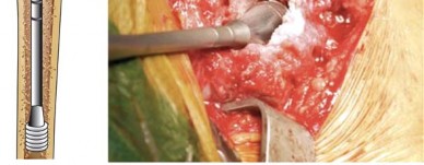 توضيح طبي: استبدال مفصل الورك الكلي بتقنية الإسمنت للفخذ: دليلك الشامل لنتائج تدوم طويلاً مع الأستاذ الدكتور محمد هطيف في صنعاء