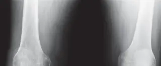 صورة توضيحية لـ استبدال مفصل الركبة بالإسمنت: دليلك الشامل لعملية ناجحة مع الأستاذ الدكتور محمد هطيف