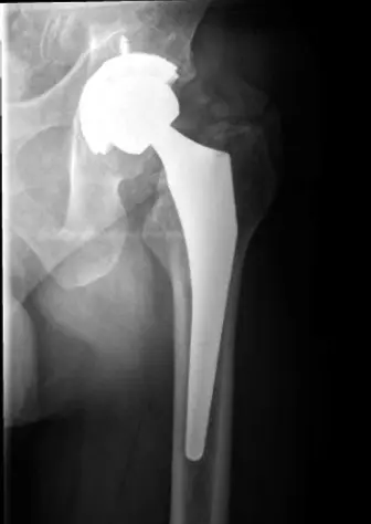 صورة توضيحية لـ شلل العصب الوركي بعد تغيير مفصل الورك: دليل شامل للمرضى