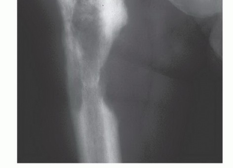 Illustration 21 for Plain Radiograph Showing MBD: Surgical Planning to Prevent Failures