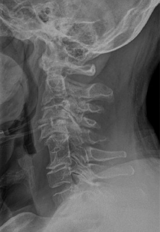 Why This Neck Injury Causes Hand Weakness: Central Cord Syndrome