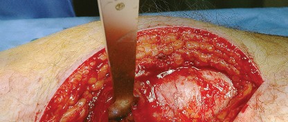 Illustration 20 for Unlock the Figure Posterior Approach to the Hip