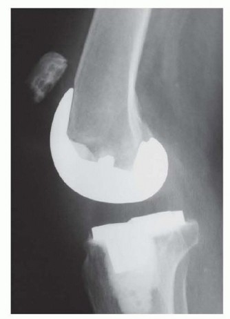 Patella Tendon Rupture Reconstruction in Revision TKA
