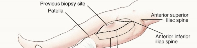 صورة طبية: استئصال ساركوما العضلة الرباعية مع الحفاظ على الطرف: دليل شامل للمرضى مع الأستاذ الدكتور محمد هطيف في صنعاء