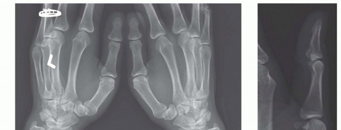 Thumb Metacarpal Extension Osteotomy