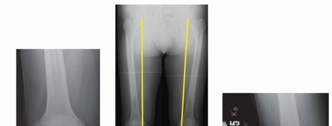 Illustration of high tibial osteotomy - Dr. Mohammed Hutaif