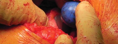 صورة طبية: تقنية الجذع القصير لاستبدال مفصل الورك الكلي: نهج الأستاذ الدكتور محمد هطيف لتدخل جراحي أقل ونتائج أفضل