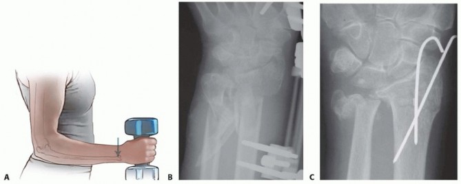 Open Reduction and Internal Fixation of Ulnar Styloid, Head, and Metadiaphyseal Fractures