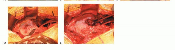 Illustration 4 for Uncemented THA: Critical Soft Tissue Tension for Joint Stability