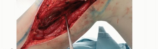 صورة أشعة رنين مغناطيسي توضح ورماً في قصبة الساق القريبة