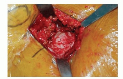 صورة توضيحية لـ نصف مفصل الورك: دليلك الشامل لدواعي الاستخدام والأنواع في صنعاء