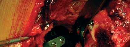 صورة طبية: طول عمر مكون الحُق الأسمنتي في مفصل الورك: مفتاح الاستقرار والديمومة مع الأستاذ الدكتور محمد هطيف في صنعاء