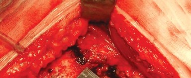 Illustration 10 for Approaches Posterolateral Surgical: A Guide to Enhanced Hip Surgery