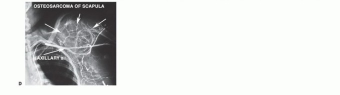 صورة توضيحية لـ الاستئصال الكلي للوح الكتف: دليل شامل للمرضى حول الجراحة، إعادة البناء والنتائج مع الأستاذ الدكتور محمد هطيف في صنعاء