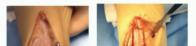 الشفاء من آلام الكاحل: الحل المتقدم لإصابات غضروف العرجون (Anterior Tibial Osteotomy)