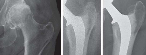 توضيح طبي: استبدال مفصل الورك الكلي بتقنية الإسمنت للفخذ: دليلك الشامل لنتائج تدوم طويلاً مع الأستاذ الدكتور محمد هطيف في صنعاء
