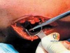 Illustration of meniscal repair meniscal repair - Dr. Mohammed Hutaif