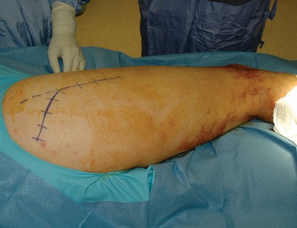 Illustration of femoral stem revision - Dr. Mohammed Hutaif