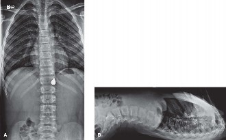 Illustration 3 for Mastering Hemivertebra Unilateral Bar Diagnosis: 12 Cases