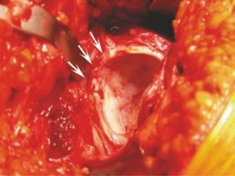 Illustration 6 for Beyond Arthroscopy: Surgical Hip Dislocation for Complex Instability