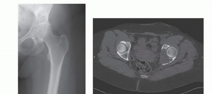 توضيح طبي: جراحة نقائل الحوض: حل شامل لآلام العظام واستعادة الحركة مع الأستاذ الدكتور محمد هطيف
