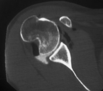 Recurrent Anterior Shoulder Instability: Comprehensive Diagnostic Approach to Hill-Sachs & Glenoid Bone Loss