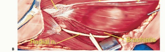 صورة توضيحية لـ استئصال الجزء البعيد من عظم العضد: تقنيات آمنة للحفاظ على الطرف في صنعاء مع الأستاذ الدكتور محمد هطيف