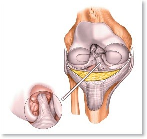 Mastering Knee Approaches: Spotlight on Superficial Medial Ligament