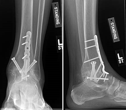 Illustration 9 for First Metatarsal Surgery: Expert Solutions for Foot & Ankle Pain