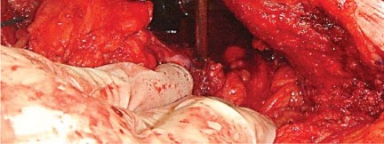 Illustration 28 for Mastering Soft Tissue Balancing for Optimal THR Outcomes