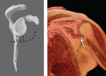 Illustration 15 for Right Shoulder Pain? Avoid This Common X-ray Mistake.