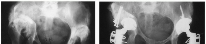 Recreate Hip Biomechanics: Modular Stems for Modular Solutions