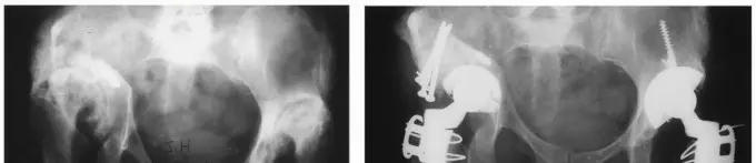 صورة توضيحية لـ استعادة حيوية مفصل الورك: السيقان المعيارية لحلول متقدمة ومخصصة
