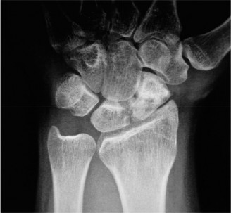 Illustration 13 for Christine M Kleinert Discussion: Solving Difficult Wrist Fractures